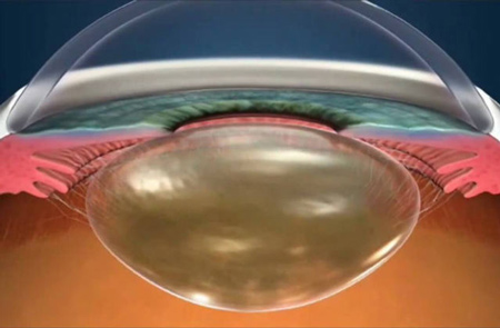 1-lentes-intraoculares1518.jpg