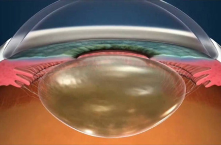 1-lentes-intraoculares1518.jpg