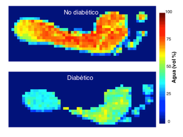 1 Imagen de pie diabetico en Terahertz