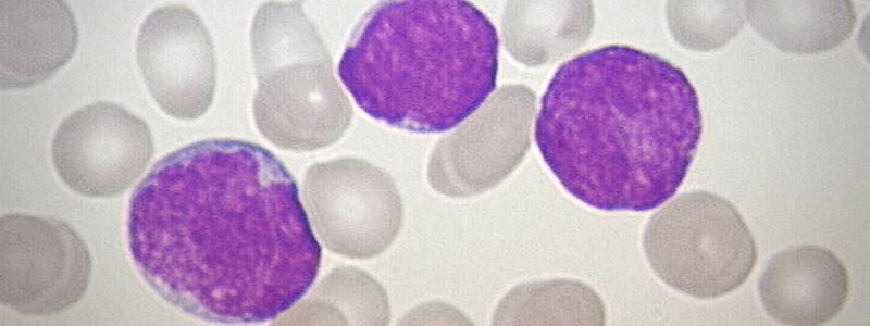 banner leucemia linfoblastica aguda nino