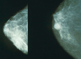 mamografia vs termografia01