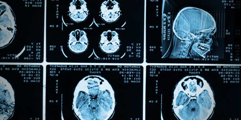 scan cerebro IGF I