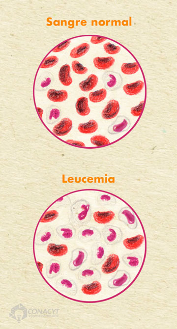 celulas leucemia02